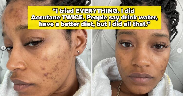 11 Celebrities Open Up About Pimples Struggles