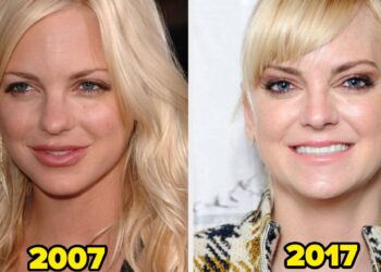 17 Celebs Who Dissolved Or Cease Getting Facial Fillers (And Why)