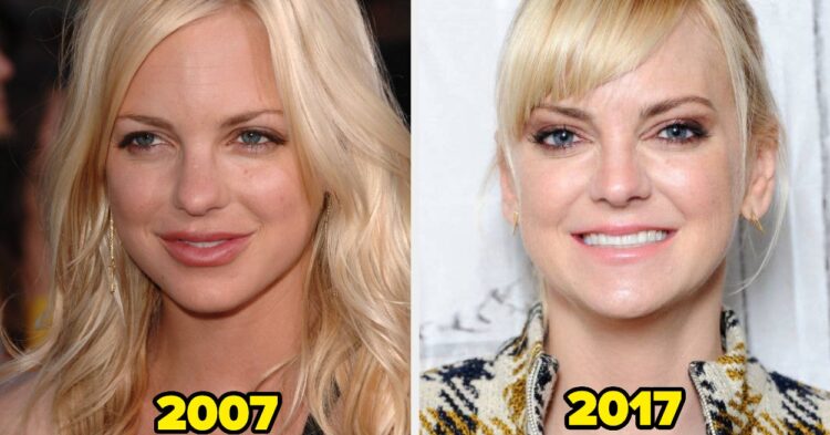 17 Celebs Who Dissolved Or Cease Getting Facial Fillers (And Why)