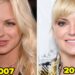 17 Celebs Who Dissolved Or Cease Getting Facial Fillers (And Why)